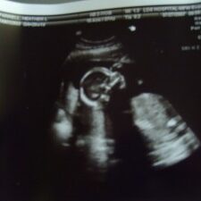 1000-miles-and-ultrasound-009-300×225-1